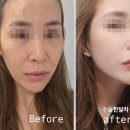 셀업성형외과 | 셀업성형외과, 실제 고객님의 더 프라임 스몰핏 한 달 변화 이야기