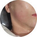 강남-200 | 강남역 피부과 울쎄라 200샷 + 턱보톡스 후기