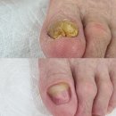 예쁜눈고운발 | 무좀으로 두꺼워진 발톱, 시니어 조갑비대증 해결하는법 광주 남구 문제성발톱 전문점 예쁜눈고운발