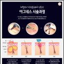 나인피부과 네이버블로그