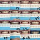 (주)스마트큐브랩스 | [화이트랩스] 내돈내산 셀프 치아미백 2주 사용 후기: 이 시림 없는 확실한 효과 (feat. 미백치약 비교)