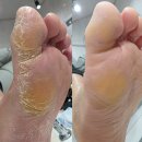 아부지 | 광주 발각질제거 엄청나게 심했던 아부지발 후기(원인이 무좀이라니..)