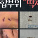 메디필성형외과 | 소아 안면 열상 봉합후기(이마, 코) 2: 드레싱배우러 화상전문병원 응급실 찾다