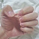 네일에스티35 | 세미 촬영 네일 케어, 문제성 손톱 해결 후기, 남구로역 에스티벨 네일숍(프렌치 네일 후기)