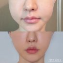 찐밤 | 심부볼 처짐 고민이라 v슬림밤 받아본 찐 후기! 지방분해주사 효과 (청담동피부과)