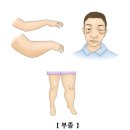 신증후군 Nephrotic syndrome 이미지