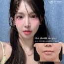 라이크성형외과의원 | 인중이 짧아졌더니 인상이 이렇게 바뀔 수 있다고요?