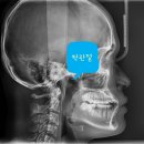 김종구희망드림치과의원 | 비수술 주걱턱 교정 바란다면, 반드시 해야할 2가지