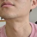 침샘보톡스 후기 귀밑샘보톡스 턱밑샘보톡스 후기