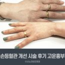 고운손병원 | 강남 손등혈관힘줄시술 2개월후 고운하지흉부외과 후기