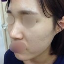 청담주앤클리닉 | 코필러후기 요기요기