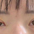 멍이랑 | 이제 슬슬 멍이 사라진다!-쌍수 재수술 3주차 후기