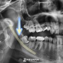 조승기치과의원 | 망우동 치과 매복 사랑니 발치 후기, '조각내어 꺼내는 이유는 무엇일까?'