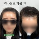 부산두피문신 M자탈모 고민 3일이면 해결! 이미지