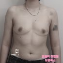 정상휴게소(Cafe on Top) | 완절 미용적 전절제와 유륜축소 수술 전후 비교