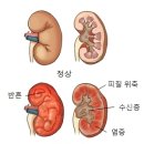 만성 신우신염(Chronic pyelonephritis)신장비뇨기 질환이란? 이미지