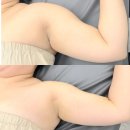 부천 팔관리 마사지 후기｜소사역 바디관리 받고 팔 붓기와 라인 관리받은 솔직 후기