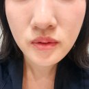 청담하트피부과의원 | [청담피부과의원] 티타늄3주차후기 비포애프터 리세티 리프팅