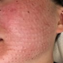 피부관리사 (주간) | ✨엠보 역대급✨ 국소마취 강남 리쥬란 힐러 4cc 내돈내산 후기