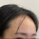 [병원후기] 칠곡 경북대학교병원 모발이식센터 상담 후기