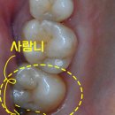 OK치과의원 | [상대원동 치과] 뼈가 얇아도 OK! 상악동 거상술로 임플란트 완성한 과정 (5개월 후기)