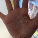 3년 넘은 손바닥 화폐상 습진 치료 한달 경과 후기 (내돈내산 처음으로 한의원에 가다)