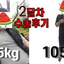 한상문 | [유튜브] 비만대사수술 2개월차 수술후기 (+사진)