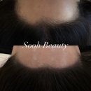 상남동173 | 창원 헤어라인 두피문신 잘하는곳 "소오뷰티" 상남동 두피문신