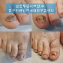 연세강인병원 | 💙 【동두천 한강연세병원】유방암 이후 심해진 무좀, 면역력 걱정과 남편 전염 고민까지… 이제 해결하세요