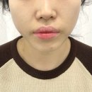 유안 | 콜라겐주사 쥬베룩볼륨 청담피부과 유안의원 팔자주름 후기
