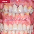 보일치과의원 | 문발동치과, “비싼 재료가 답일까?” 보철치료 진짜 선택법