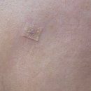 차명수연세피부과의원 | 송도 연세피부과의원에서 점제거한 후기