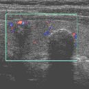 Papillary carcinoma of the thyroid 이미지