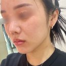 더채움 | 강남 논현역 피부과 팔자필러 더채움 1cc 후기