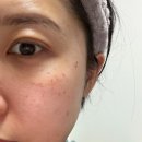 강남대중한의원 | 강남역 한의원 기미잡티 레이저 잘하는곳 l 1주차 전후비교 솔직 후기