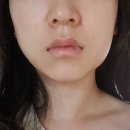 디아트 치과 사랑니 발치후기