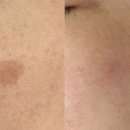 리메디뷰티아카데미룩서스플라즈마라이너노원지사