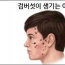 검버섯이 생기는 이유 검버섯 예방과 치료 이미지