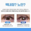 망막색소변성증 쇼그렌증후군 망막박리 원인 증상 이미지