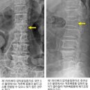 압박골절[compression fracture] 이미지