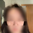 [내돈내산] 맑은참피부과에서 흑자 제거 후기 1탄🌟