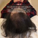 딜리버즈뷰티 | 울산탈모치료 (모발이식부작용) 생장술 3개월 후기