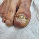 포쉬네일 풀리메디 안산점 | 안산 고잔동 발톱무좀 내성발톱 믿기 힘든 관리 효과 포쉬네일 동성제약 풀리메디 안산점