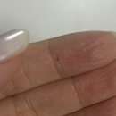 디자인선 | 비절개 여자 모발이식 2주차 3주차 내돈내산 후기 각질과 변화