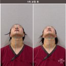 무척바른한의원 | 부산 안면비대칭 교정 후기, 한의원에서 첫 진행 후 눈에 띄는 변화!