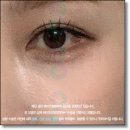 828 B | 눈밑지방재배치 수술 후기 완벽 정리! 가격부터 붓기 과정과 통증 정도까지 공유해요