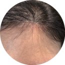 시민로 | [의정부] 탈모병원, 피부과 (탈모치료, 5회차 관리 후기)