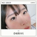 아이멍 | 인천 쥬베룩아이 송도성형외과1차받은후기 통증 멍 붓기관리
