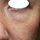 때빼멍 | 눈밑지방재배치 멍 붓기 빨리 빼주는 재생 홈케어 후기