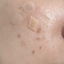 평촌자연과한의원 | 평촌역 한의원 어붐야그 레이저 기미·사마귀 제거 후기